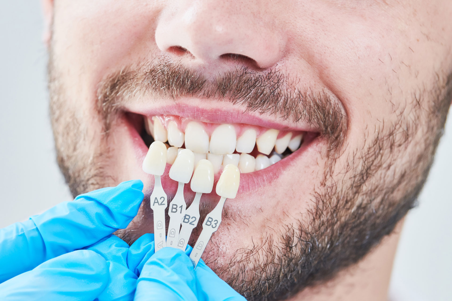 dentist matching color of patient's tooth enamel with whitening chart